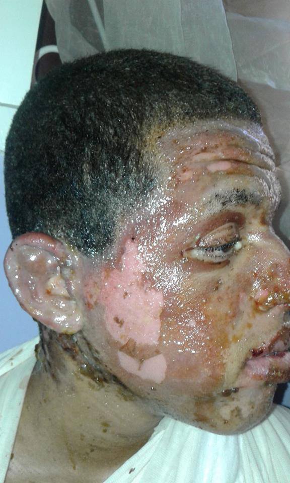 القنيطرة : قنينة غاز تسفر عن إصابات خطيرة